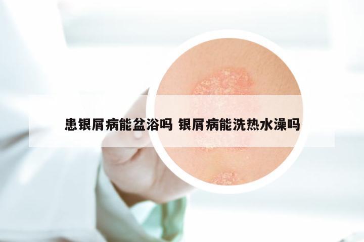 患银屑病能盆浴吗 银屑病能洗热水澡吗