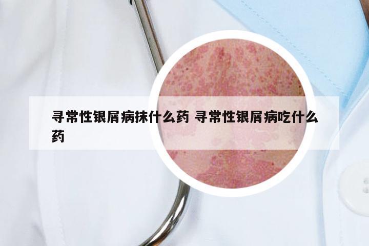 寻常性银屑病抹什么药 寻常性银屑病吃什么药