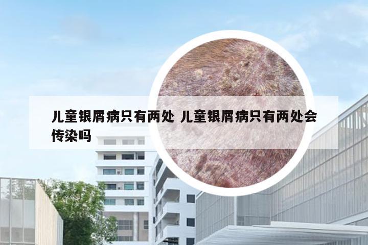 儿童银屑病只有两处 儿童银屑病只有两处会传染吗