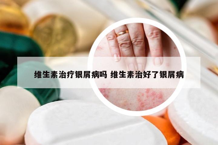 维生素治疗银屑病吗 维生素治好了银屑病