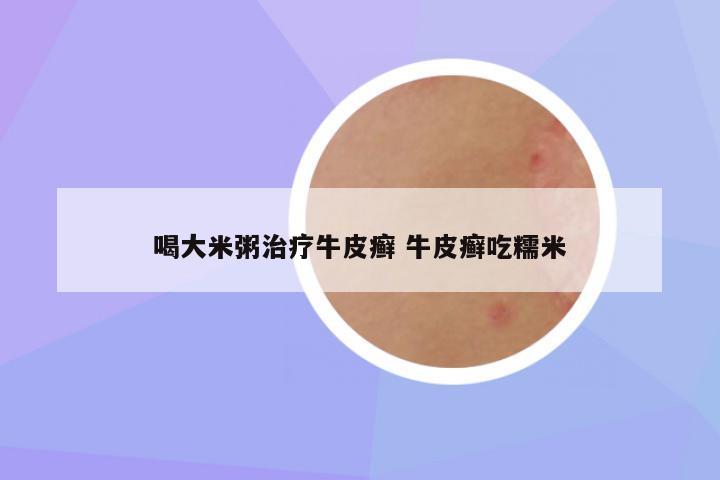 喝大米粥治疗牛皮癣 牛皮癣吃糯米