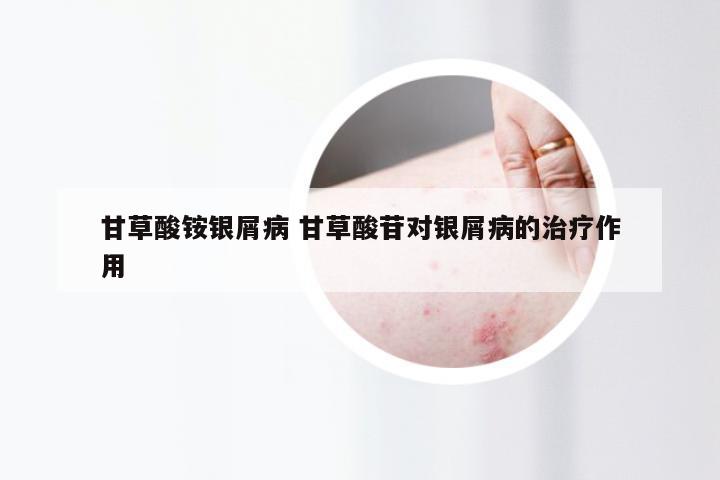 甘草酸铵银屑病 甘草酸苷对银屑病的治疗作用