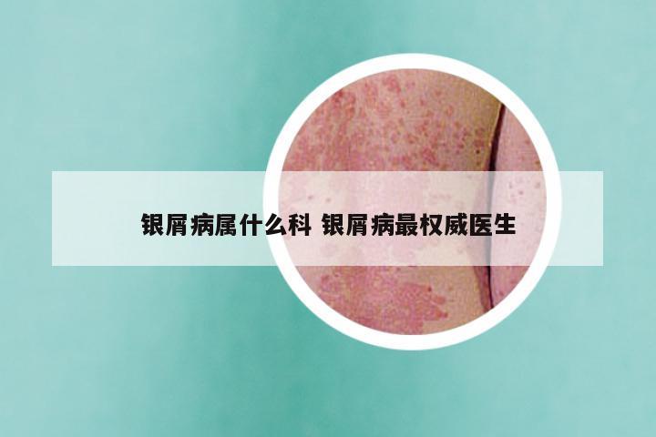 银屑病属什么科 银屑病最权威医生