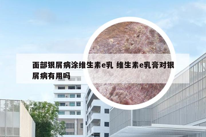 面部银屑病涂维生素e乳 维生素e乳膏对银屑病有用吗