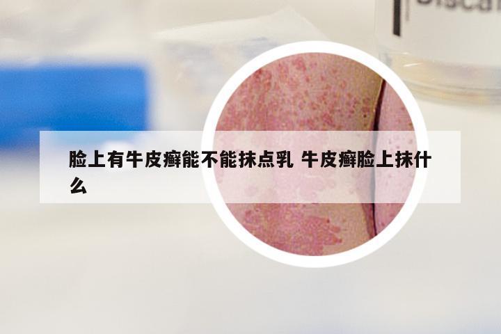脸上有牛皮癣能不能抹点乳 牛皮癣脸上抹什么