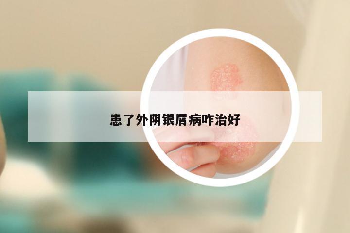 患了外阴银屑病咋治好