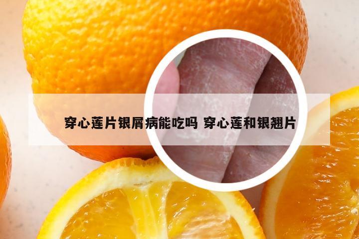 穿心莲片银屑病能吃吗 穿心莲和银翘片