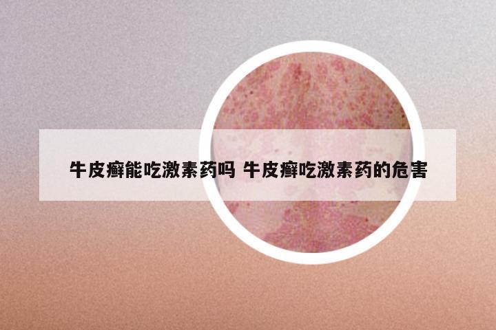 牛皮癣能吃激素药吗 牛皮癣吃激素药的危害
