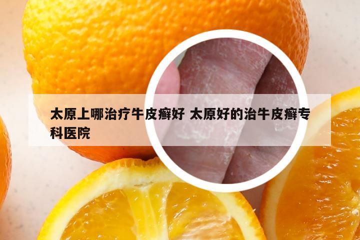 太原上哪治疗牛皮癣好 太原好的治牛皮癣专科医院
