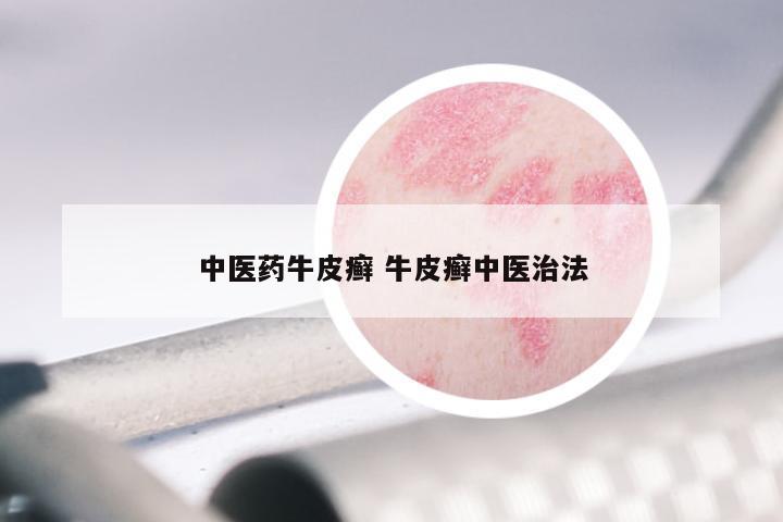 中医药牛皮癣 牛皮癣中医治法