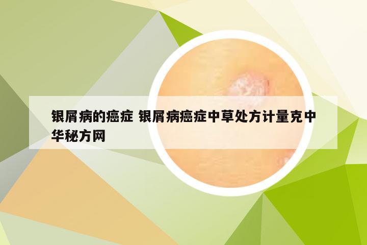 银屑病的癌症 银屑病癌症中草处方计量克中华秘方网