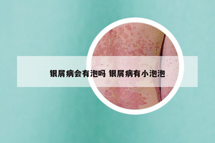 银屑病会有泡吗 银屑病有小泡泡