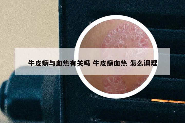 牛皮癣与血热有关吗 牛皮癣血热 怎么调理