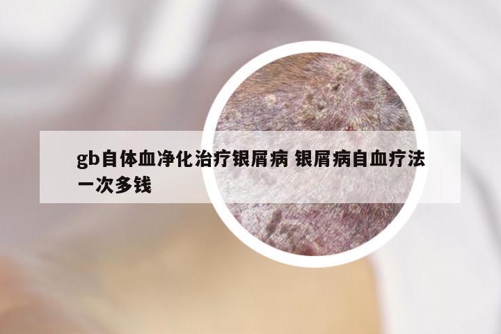 gb自体血净化治疗银屑病 银屑病自血疗法一次多钱