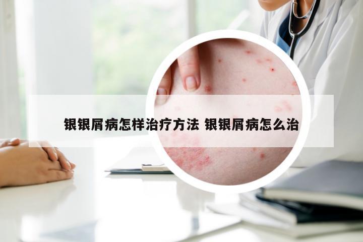 银银屑病怎样治疗方法 银银屑病怎么治