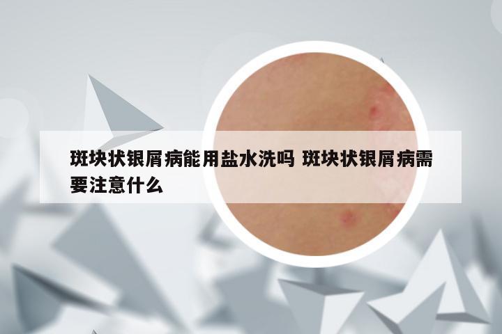 斑块状银屑病能用盐水洗吗 斑块状银屑病需要注意什么