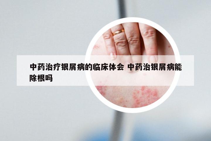 中药治疗银屑病的临床体会 中药治银屑病能除根吗