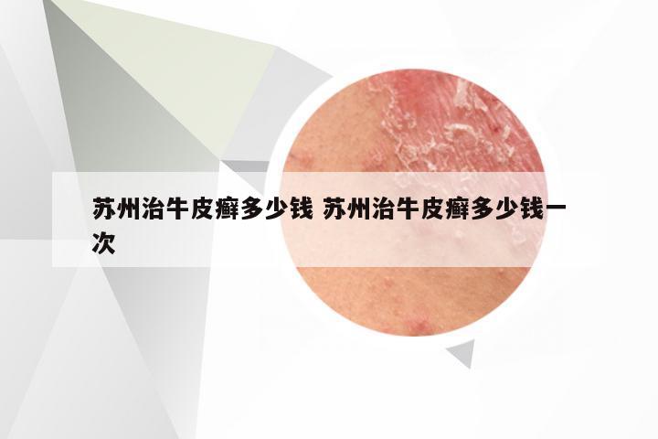 苏州治牛皮癣多少钱 苏州治牛皮癣多少钱一次