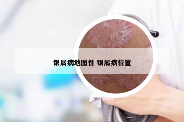 银屑病地图性 银屑病位置