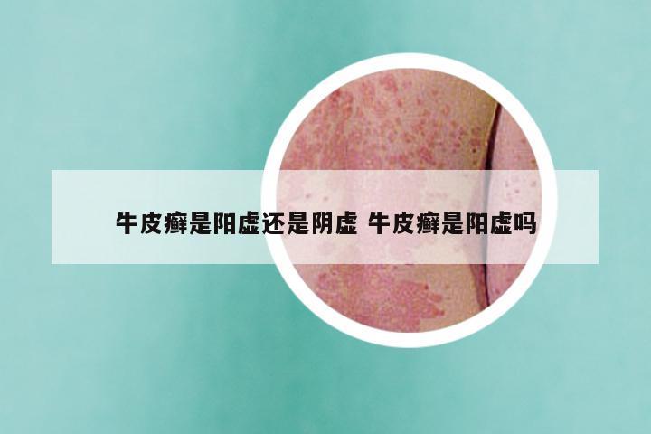 牛皮癣是阳虚还是阴虚 牛皮癣是阳虚吗