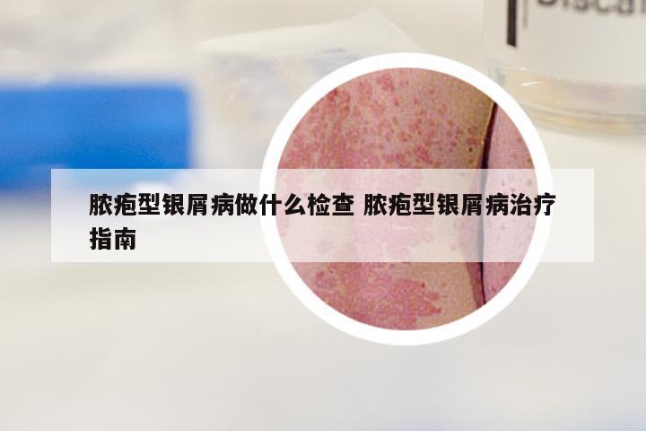 脓疱型银屑病做什么检查 脓疱型银屑病治疗指南
