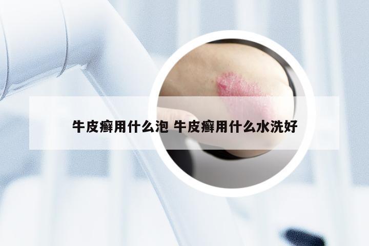 牛皮癣用什么泡 牛皮癣用什么水洗好