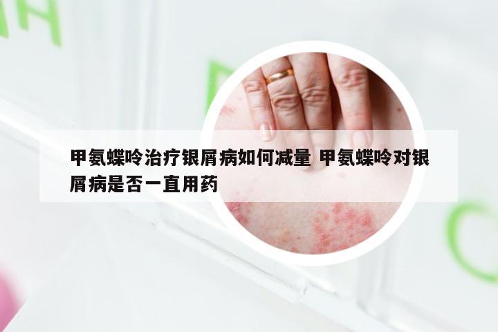 甲氨蝶呤治疗银屑病如何减量 甲氨蝶呤对银屑病是否一直用药