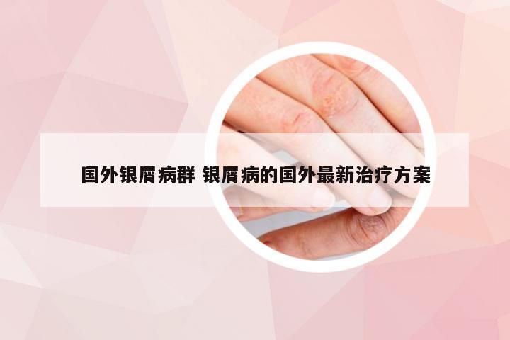 国外银屑病群 银屑病的国外最新治疗方案