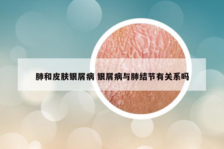 肺和皮肤银屑病 银屑病与肺结节有关系吗