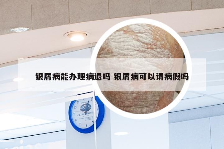 银屑病能办理病退吗 银屑病可以请病假吗