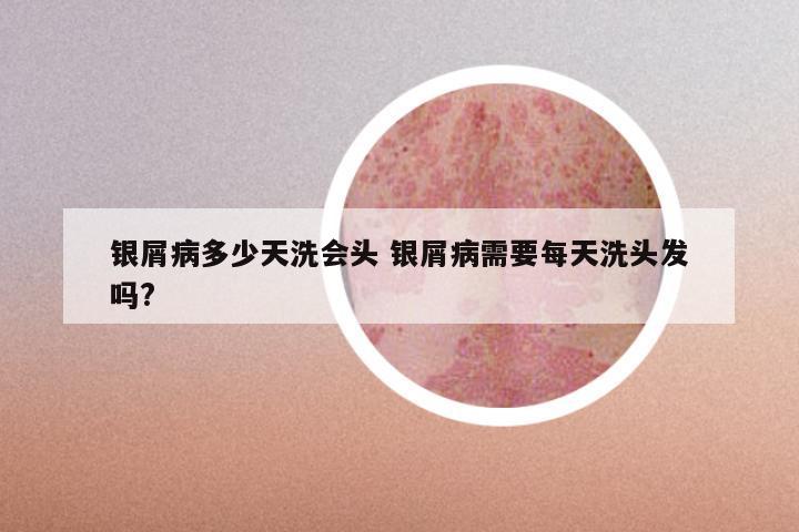 银屑病多少天洗会头 银屑病需要每天洗头发吗?