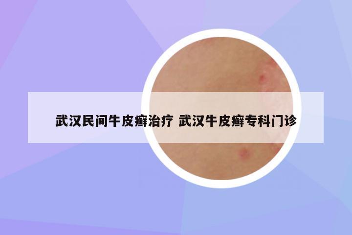 武汉民间牛皮癣治疗 武汉牛皮癣专科门诊