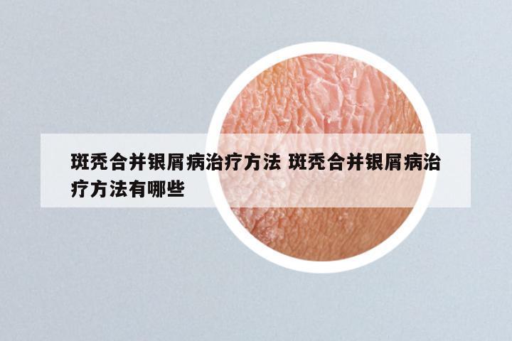 斑秃合并银屑病治疗方法 斑秃合并银屑病治疗方法有哪些