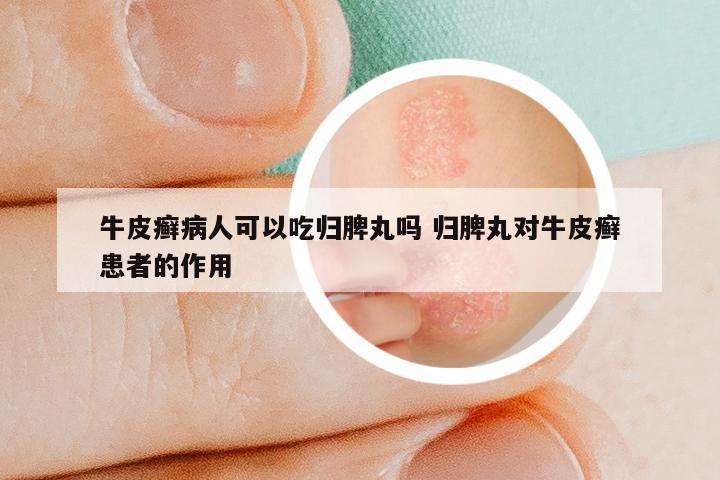 牛皮癣病人可以吃归脾丸吗 归脾丸对牛皮癣患者的作用