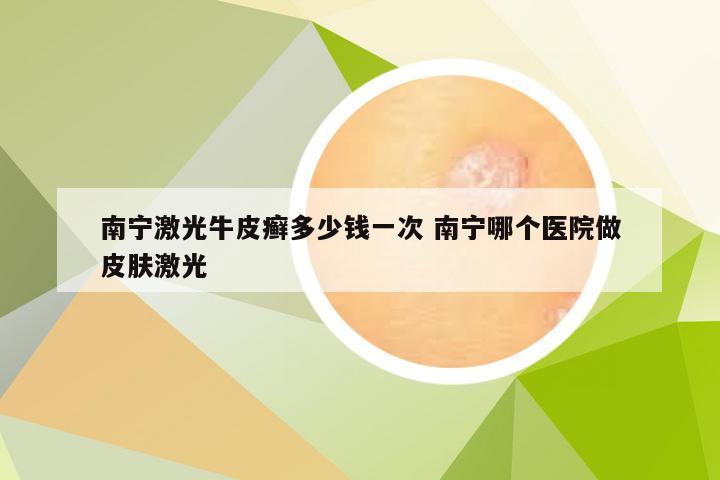 南宁激光牛皮癣多少钱一次 南宁哪个医院做皮肤激光