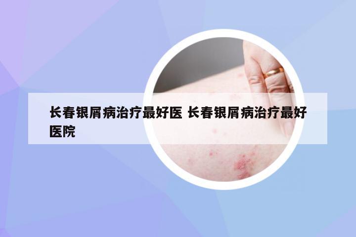 长春银屑病治疗最好医 长春银屑病治疗最好医院