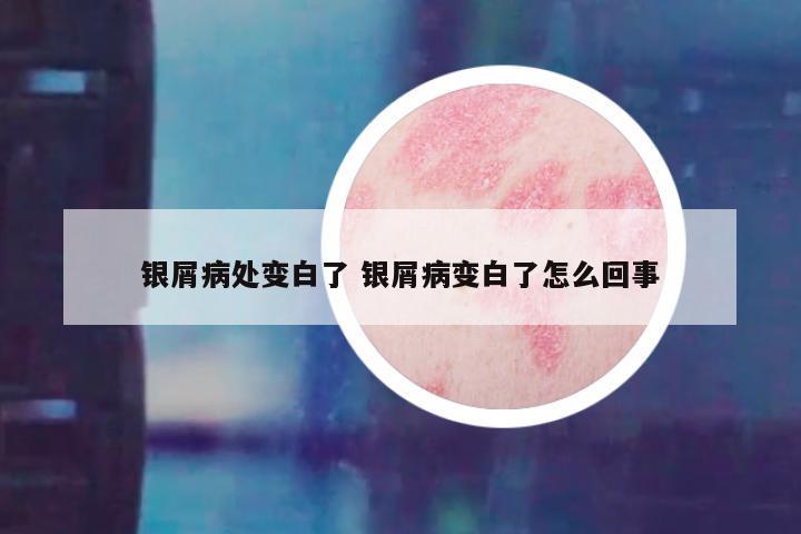 银屑病处变白了 银屑病变白了怎么回事