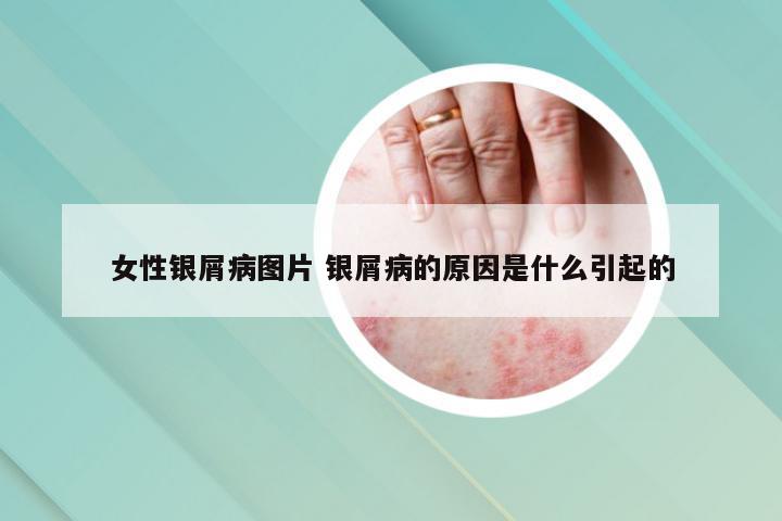女性银屑病图片 银屑病的原因是什么引起的