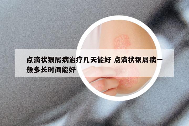 点滴状银屑病治疗几天能好 点滴状银屑病一般多长时间能好