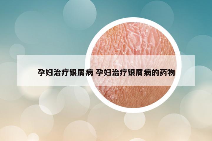 孕妇治疗银屑病 孕妇治疗银屑病的药物