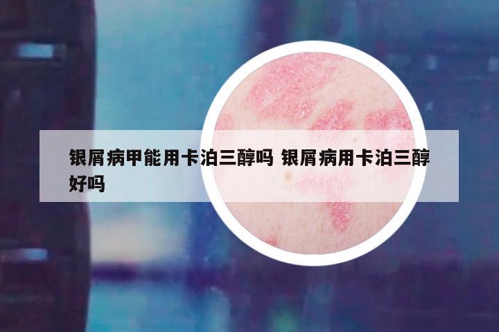银屑病甲能用卡泊三醇吗 银屑病用卡泊三醇好吗