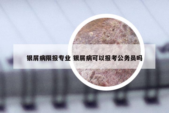 银屑病限报专业 银屑病可以报考公务员吗