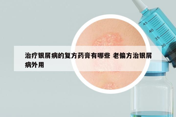 治疗银屑病的复方药膏有哪些 老偏方治银屑病外用