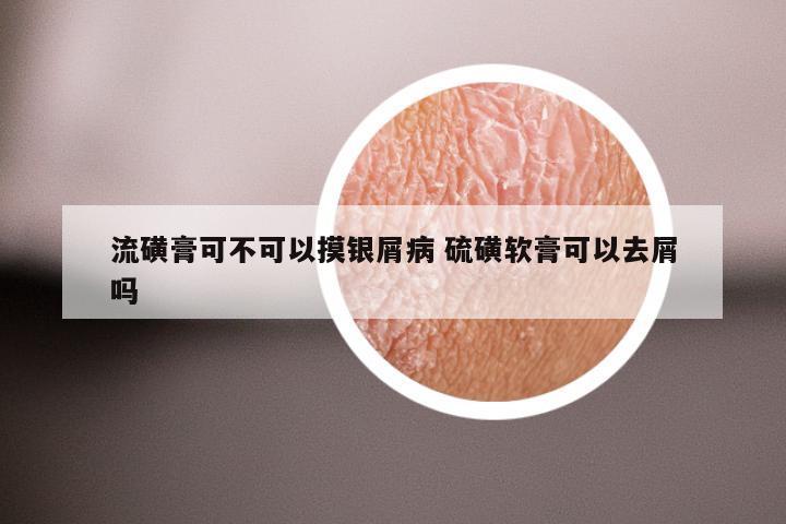 流磺膏可不可以摸银屑病 硫磺软膏可以去屑吗
