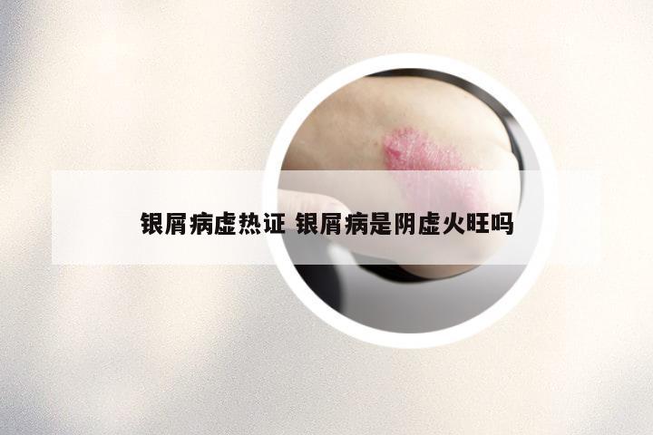 银屑病虚热证 银屑病是阴虚火旺吗