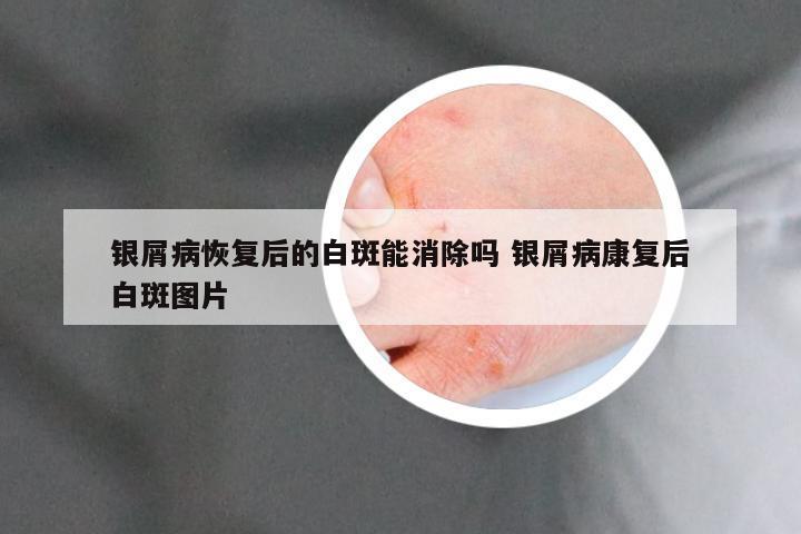 银屑病恢复后的白斑能消除吗 银屑病康复后白斑图片
