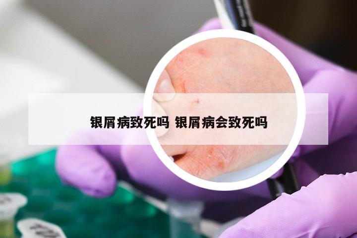 银屑病致死吗 银屑病会致死吗