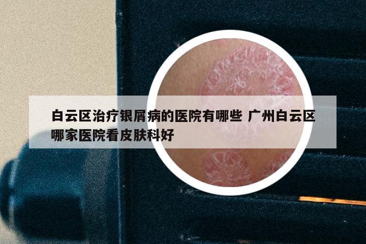 白云区治疗银屑病的医院有哪些 广州白云区哪家医院看皮肤科好