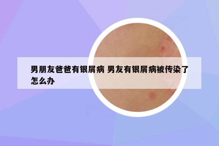 男朋友爸爸有银屑病 男友有银屑病被传染了怎么办