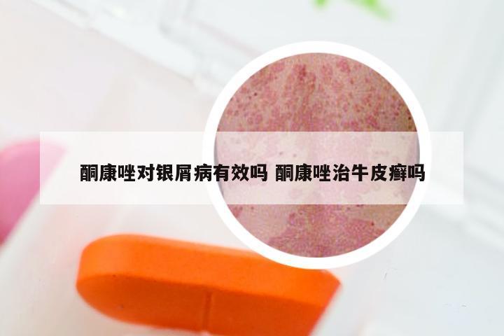 酮康唑对银屑病有效吗 酮康唑治牛皮癣吗